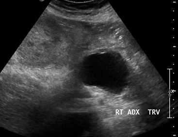 US 3-13, cyst near renal tx.jpg